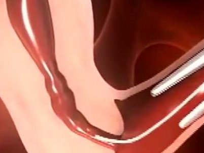 卵巢早衰去泉州做三代试管麻烦吗？需要花费多少钱？