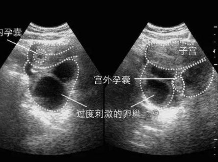上海仁济北院三代试管多少钱？